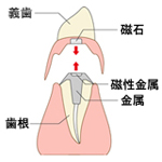 局部床義歯