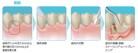 炎症性肉芽組織、歯垢、歯石の除去